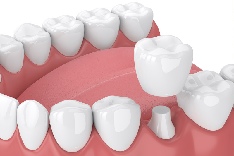Glidewell.io™ Same-Day Crowns in Carrollton