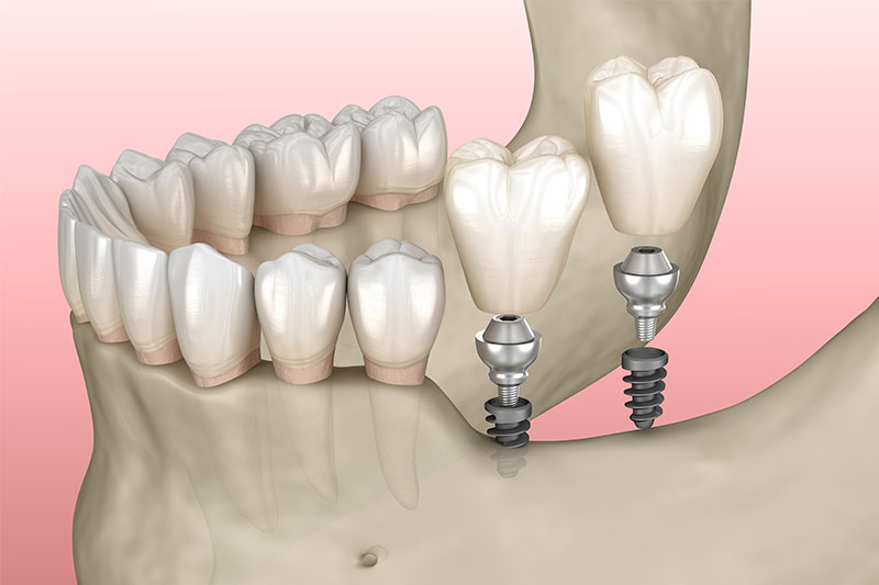 Mini-Dental Implants in Carrollton