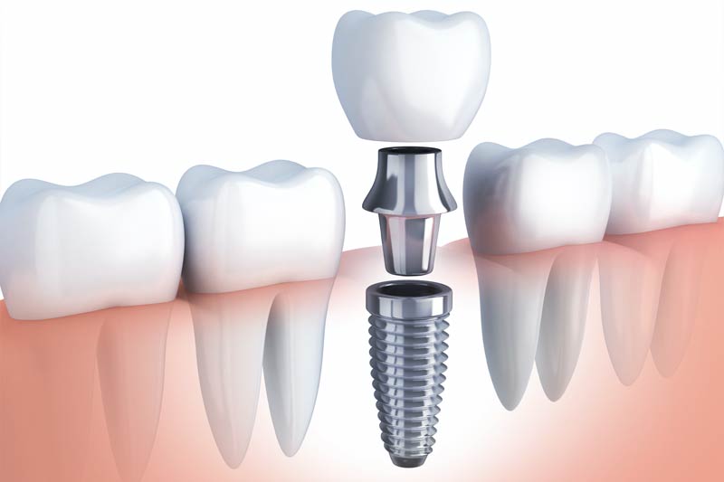 Dental Implants in Carrollton