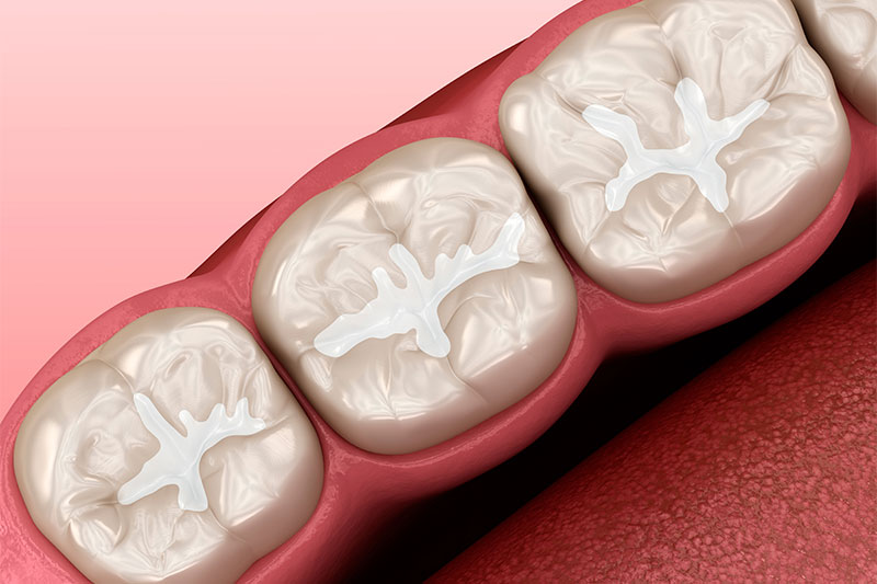 Dental Sealants in Carrollton