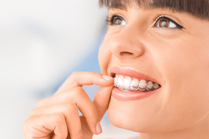 Invisalign Clear Aligners in Carrollton