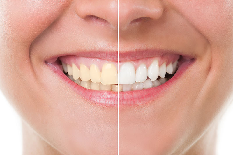 Teeth whitening in Carrollton