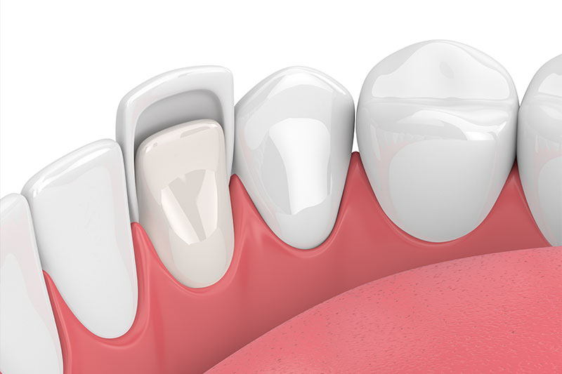 Dental Veneers in Carrollton